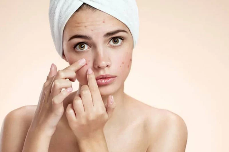 10 Things to Know About Taking Care of Acne